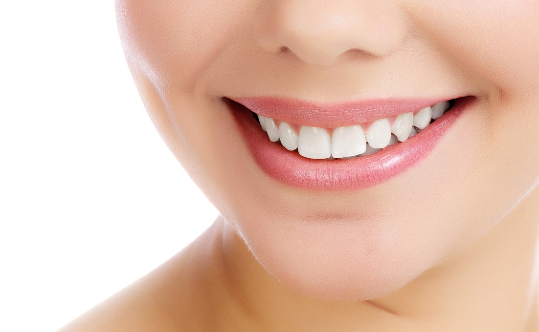 Veneers Image